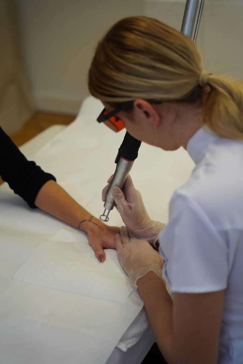 Détatouage laser - photo 1