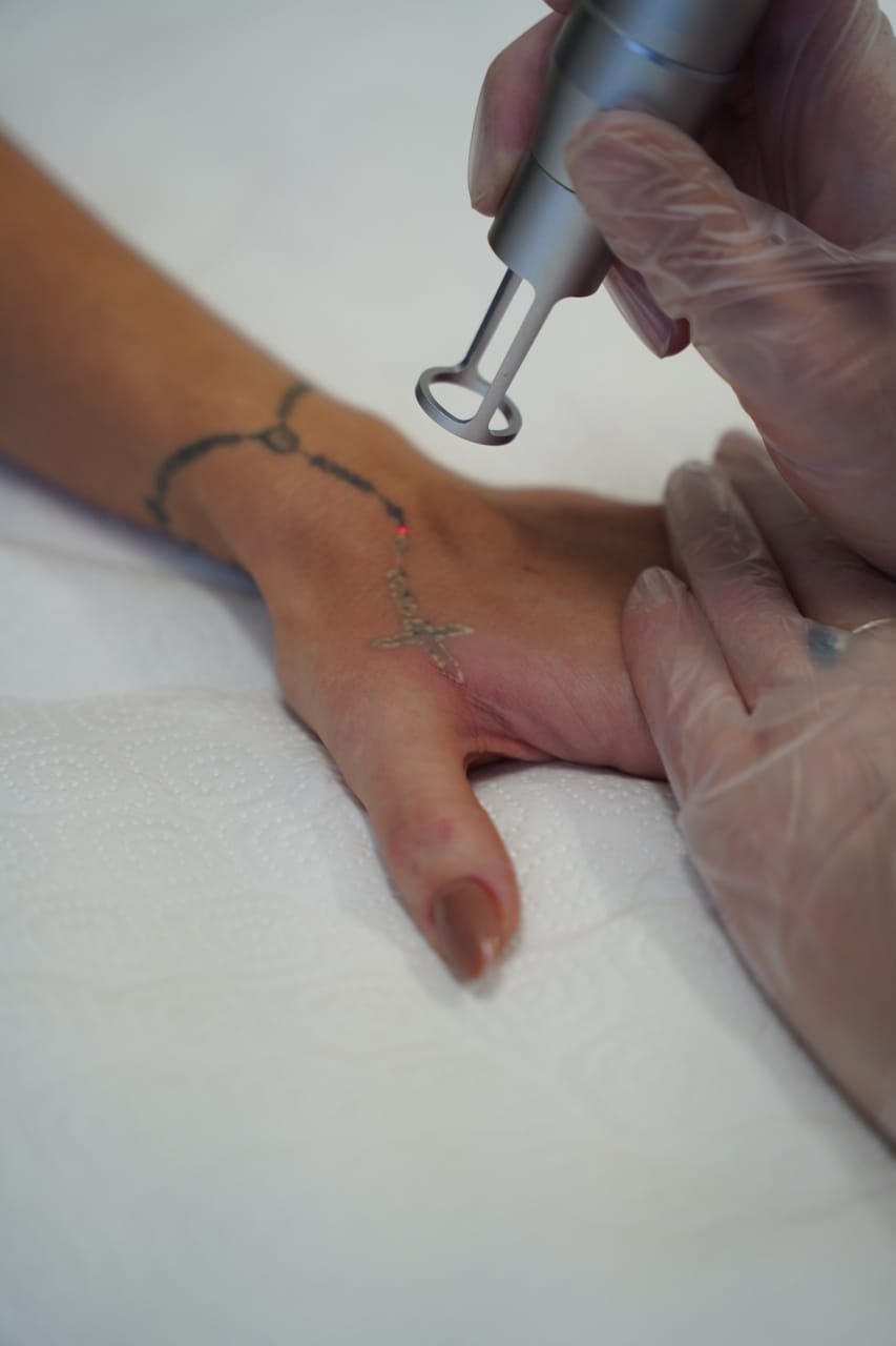 Détatouage laser - photo 2