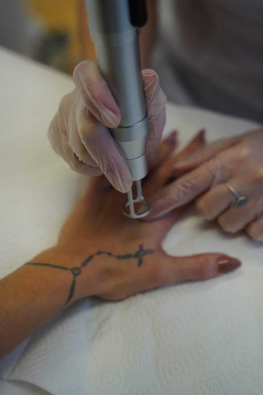 Détatouage laser - photo 3