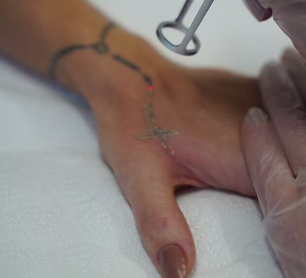 Détatouage laser